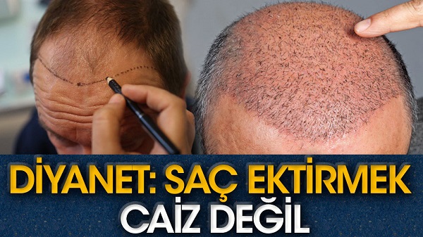 Diyanet’ten ‘saç ekimi’ fetvası